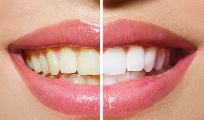 Clareamento Dental Clareamento Dental