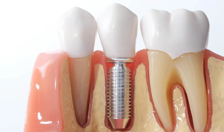 Implantes Dentarios Implantes Dentarios