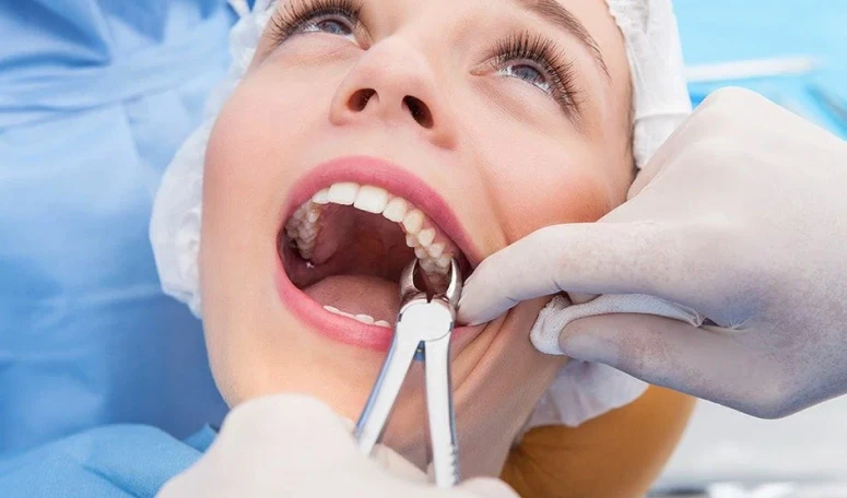 Extracoes Do Dente Siso Extracoes Do Dente Siso