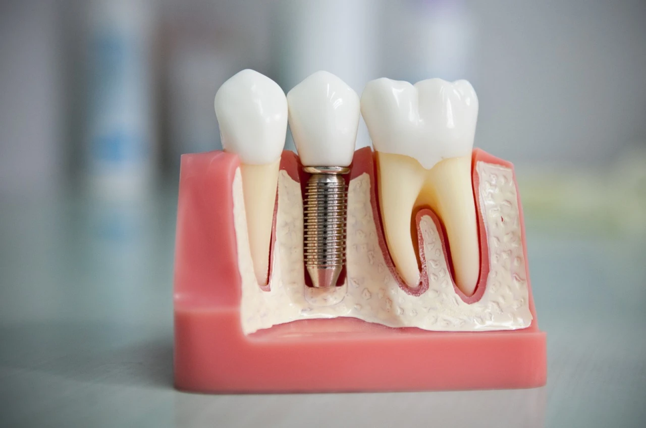 Implante Dentario Implante Dentário