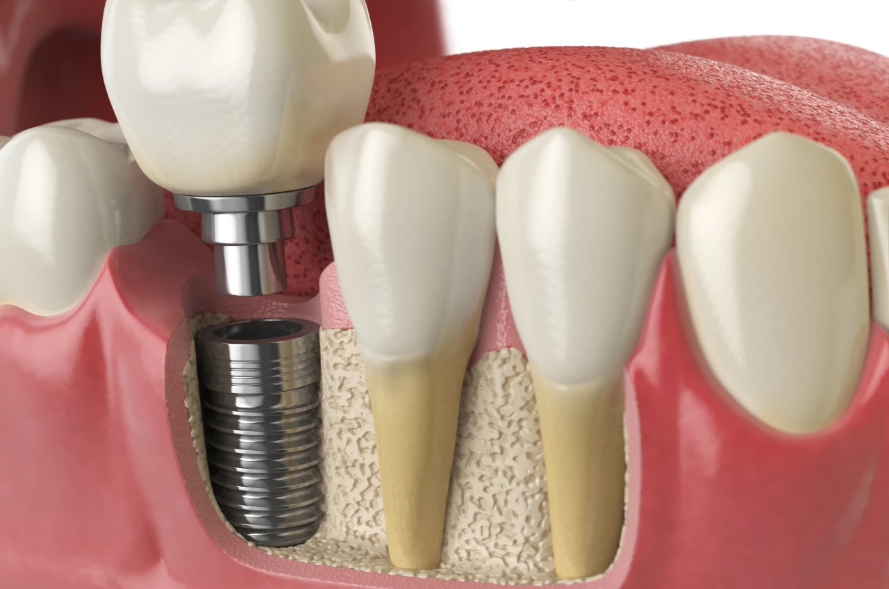 1 Implante Dentario 1 Implante Dentario