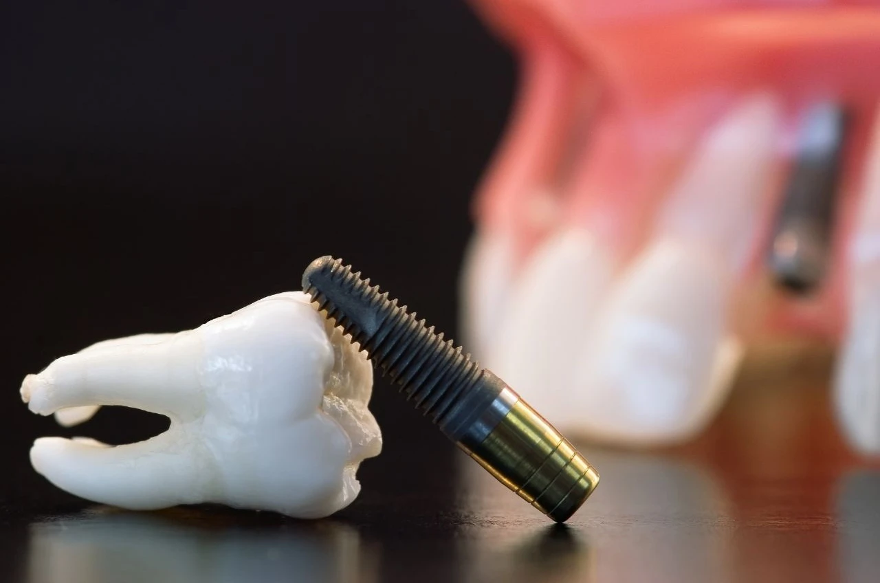 3 Duvida Sobre Implante Dentario Dentista Em Campinas Dr Filipe Cassani 3 Duvida Sobre Implante Dentario Dentista Em Campinas Dr Filipe Cassani