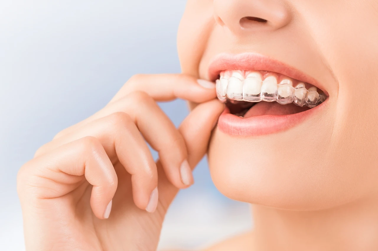 Paciente Sorrindo Com O Aparelho Invisalign Mostrando A Natureza Discreta Do Tratamento Paciente Sorrindo Com O Aparelho Invisalign Mostrando A Natureza Discreta Do Tratamento