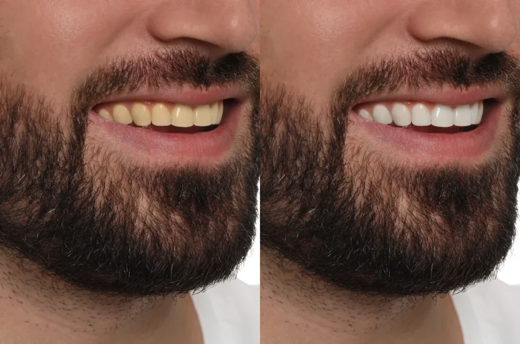 Antes E Depois De Clareamento Dental A Laser Antes E Depois De Clareamento Dental A Laser