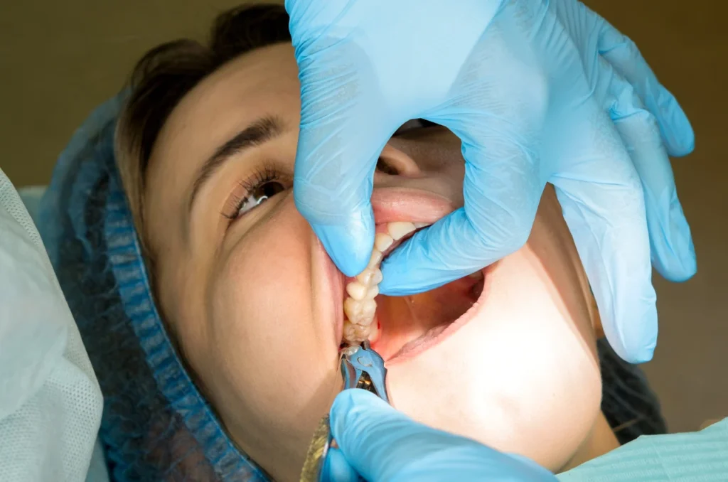 Dentista Realizando Extracao De Dente Siso Dentista Realizando Extracao De Dente Siso