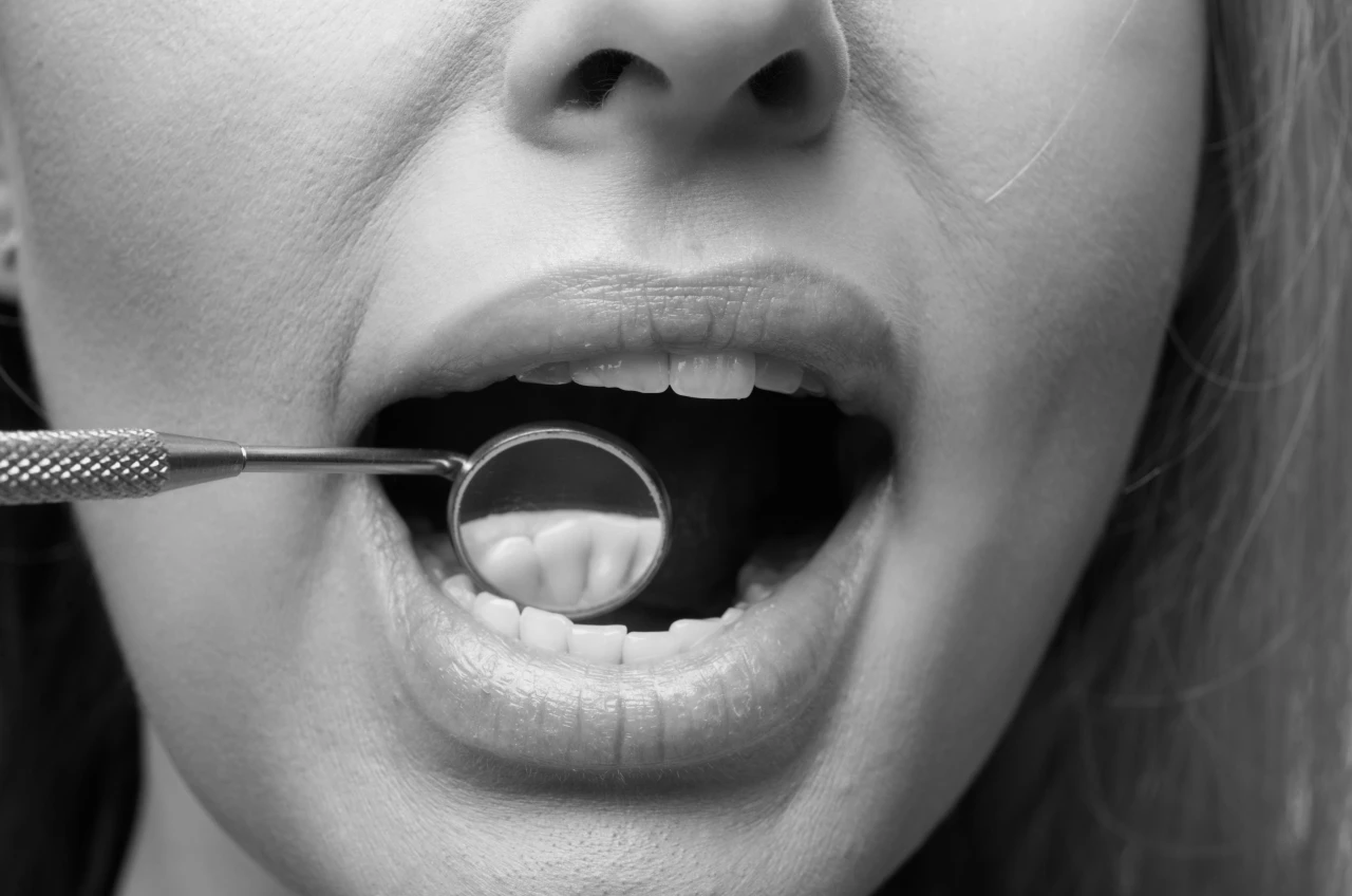 Caries E Estetica Dentaria Caries E Estetica Dentaria