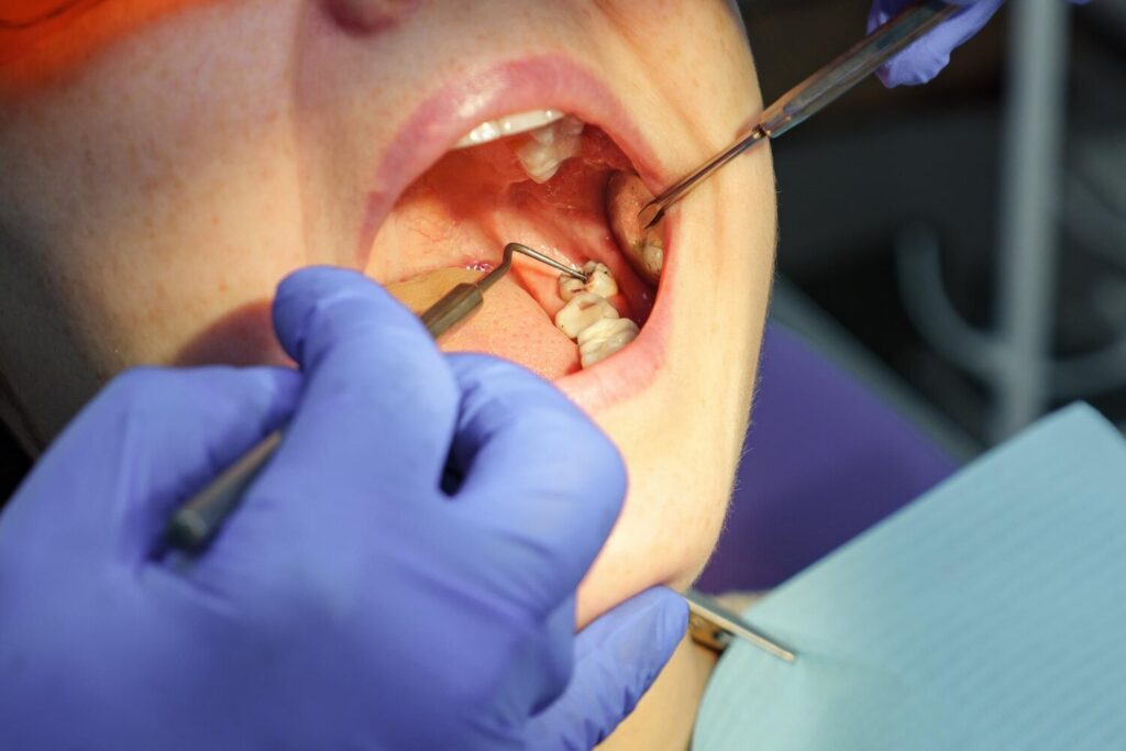 Dentist Examines Patient S Tooth With Black Cavity It Using Dental Tools Mirror Tooth Decay Opening Mouth Closeup 255755 7406 Dentist Examines Patient S Tooth With Black Cavity It Using Dental Tools Mirror Tooth Decay Opening Mouth Closeup 255755 7406
